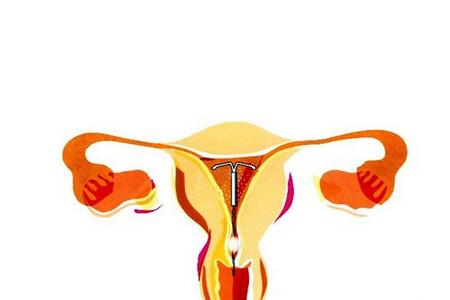 绝经后要不要取环