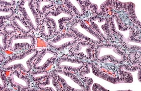 為什么輸卵管復通術后懷不上？