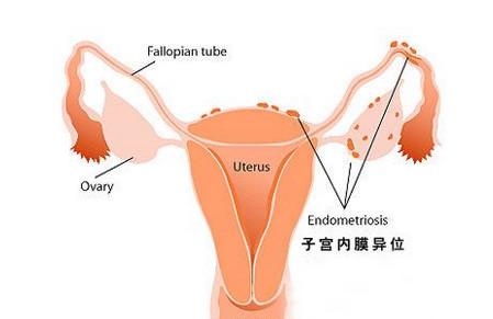 患有子宫内膜异位症怎么办？
