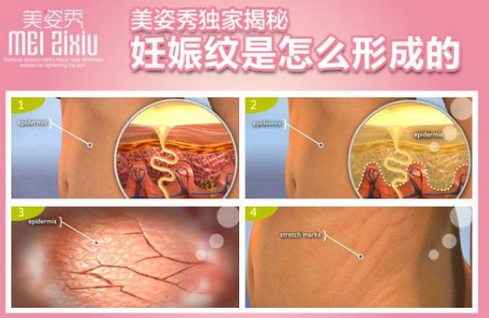 去妊娠纹最好的产品，用过美姿秀的都说好
