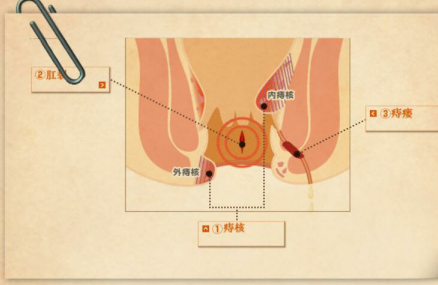 痔疮的最佳治疗方法，长了痔疮怎么办会自然好么