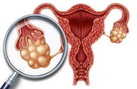 输卵管粘连要怀孕怎么办