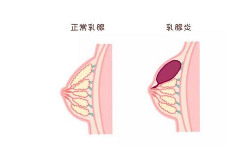 为什么产后得乳腺炎