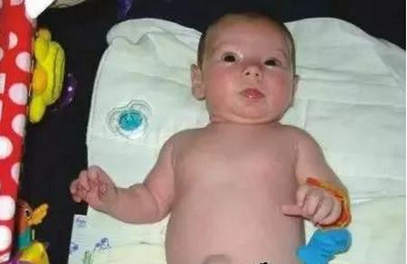  宝宝脐疝气怎么回事 如何护理患脐疝的宝宝