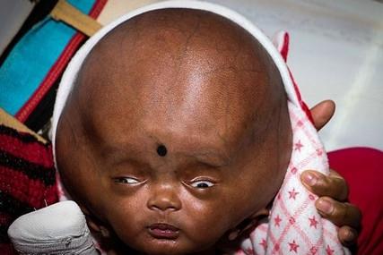 宝宝出现脑水肿是怎么回事