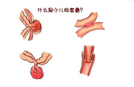 儿童肠套叠的典型症状