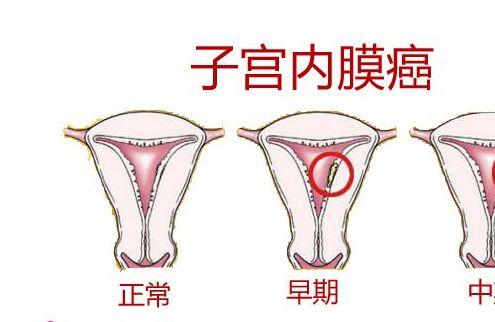多囊卵巢综合症怎么回事