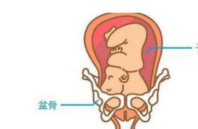 胎儿一直不入盆不能顺产吗