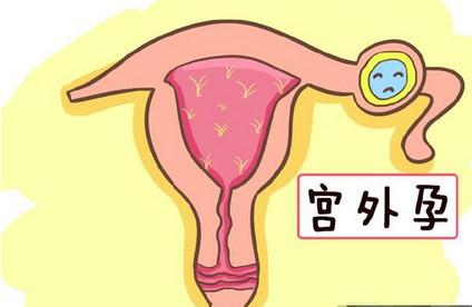 宫外孕的孕妇越来越多是怎么回事