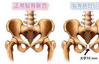 怀孕后耻骨为什么会痛