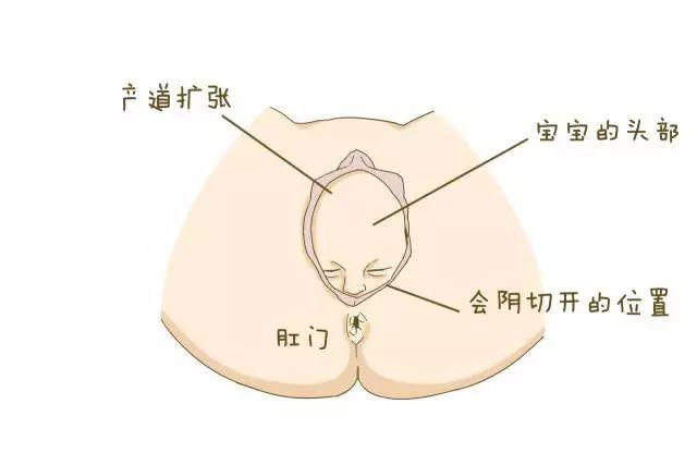 关于顺产侧切需了解什么
