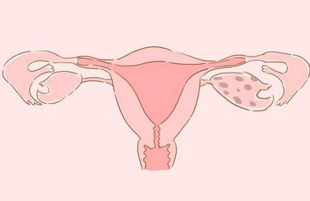 月经不调与宫外孕之间有关系