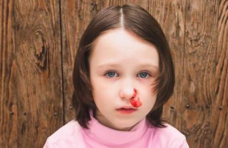 宝宝总流鼻血的原因有哪些
