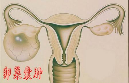 如何应对卵巢囊肿