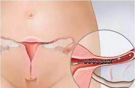 输卵管堵塞是什么原因造成的?