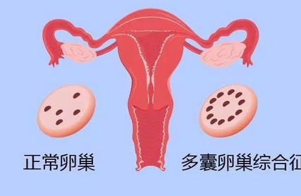 多囊卵巢综合征的表现和危害