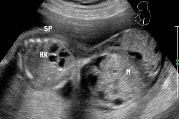 胎儿骶尾部畸胎瘤的类型