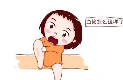 孕期缓解静脉曲张的方法有哪些