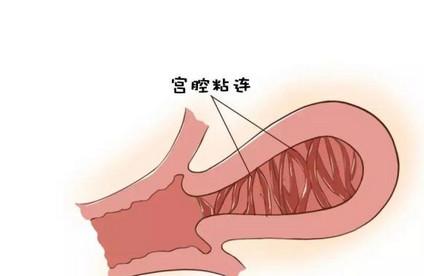 宫腔粘连是怎么回事