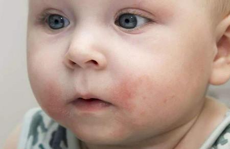 宝宝湿疹是怎么引起的？
