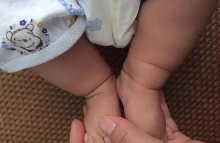 宝宝腿纹不对称怎么回事