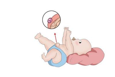 宝宝脐带掉了之后肚脐凸出来了是怎么回事