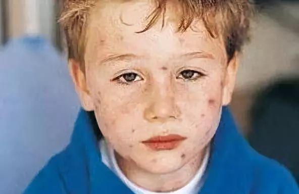 孩子皮肤出现小红疹是怎么回事