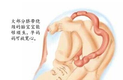 孕期怎么避免胎儿脐带绕颈