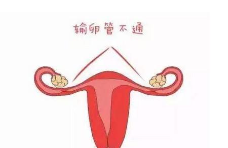 输卵管备孕的必要条件有哪些
