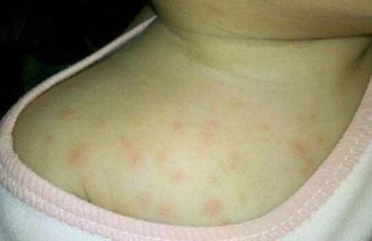 小儿季节性湿疹的原因是什么