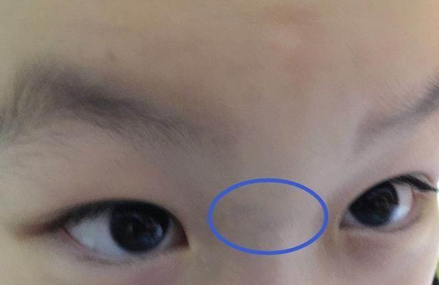 宝宝出现什么胎记需留意