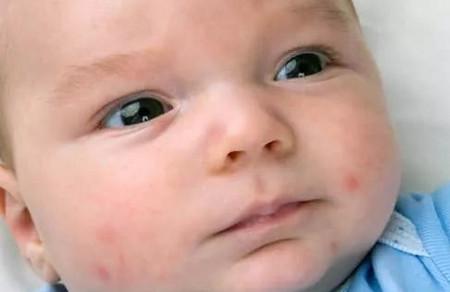 婴幼儿湿疹的护理方法