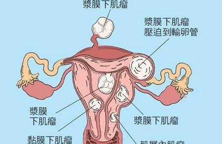子宫肌瘤对怀孕的影响有哪些?