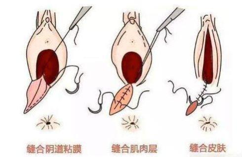 产妇顺产一定会侧切吗