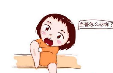 孕期能够缓解静脉曲张的方法有哪些