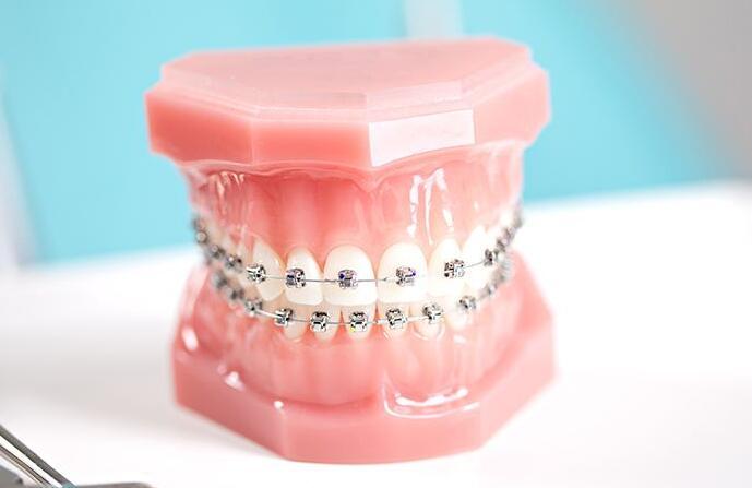 儿童牙齿矫正需要多长时间