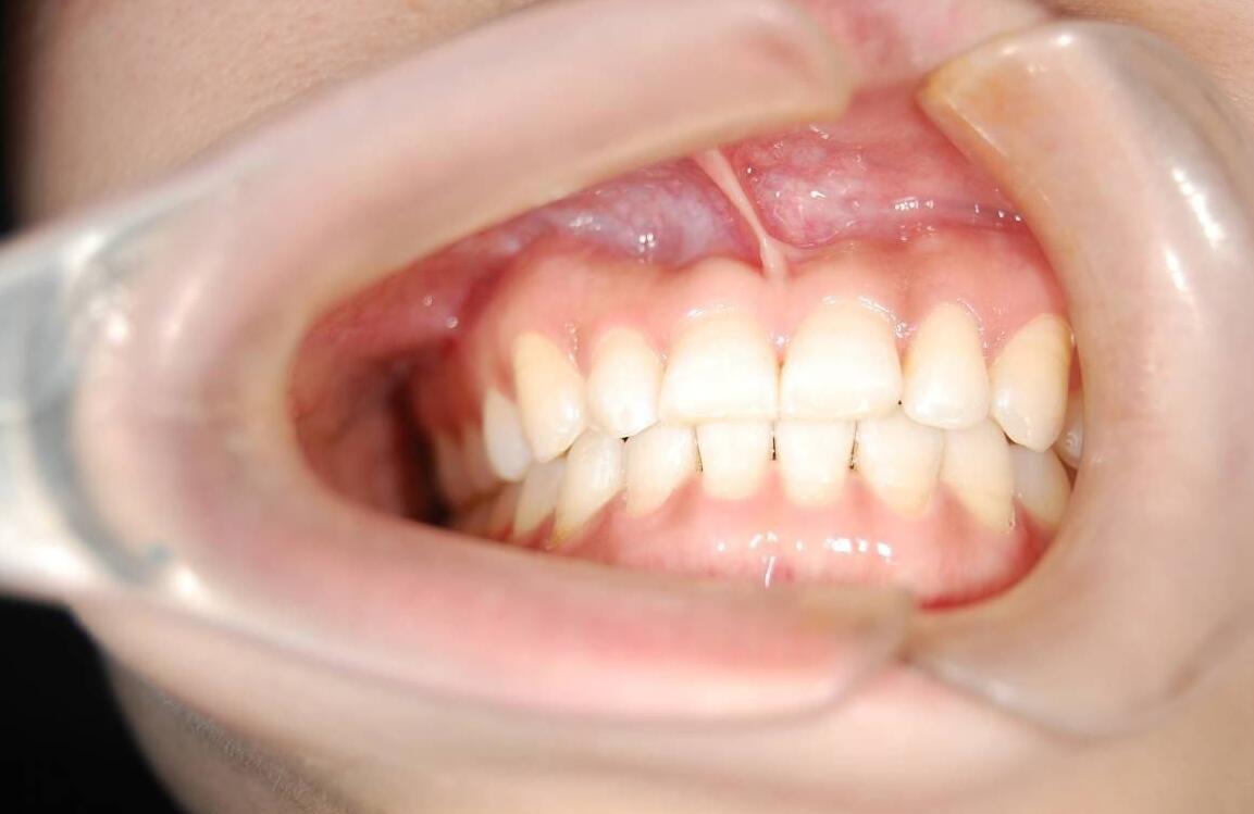 儿童牙齿畸形的原因是什么