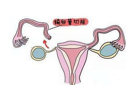 一侧输卵管还能怀孕吗？
