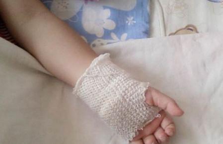 孩子被烫伤的急救方法