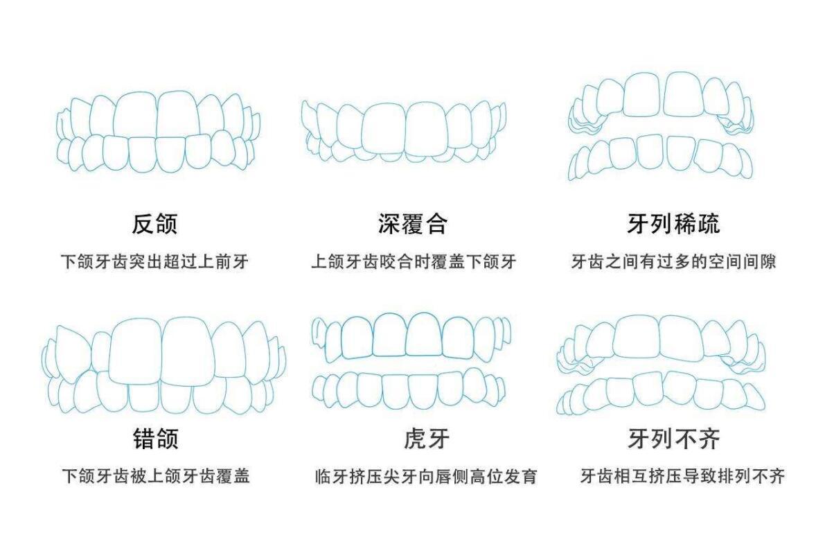 儿童牙齿畸形的种类