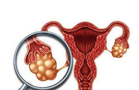 多囊卵巢综合征会遗传吗