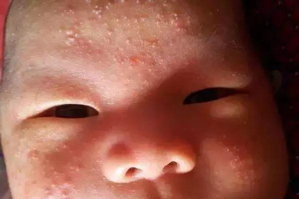 湿疹反复折磨宝宝怎么办