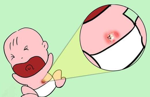 新生儿脐带流水是怎么回事