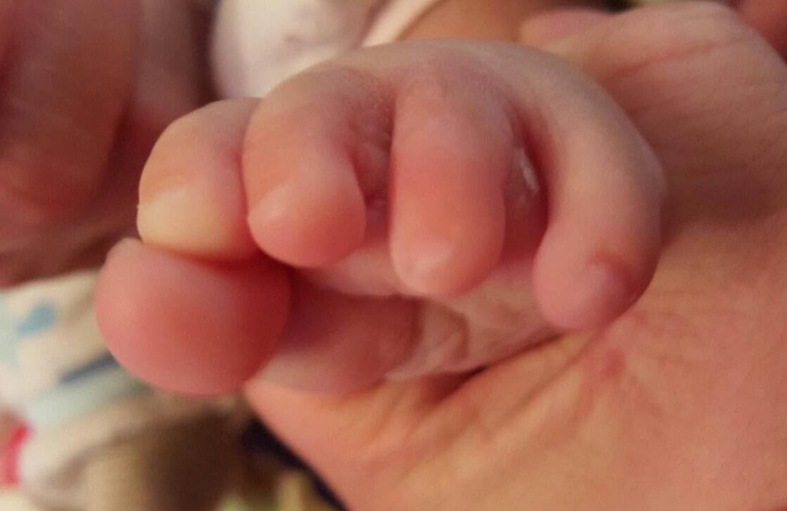 婴儿身上脱皮正常吗