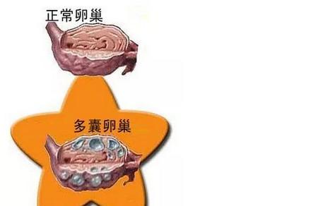 多囊备孕需要注意什么