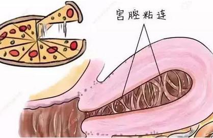 宫腔粘连的原因是什么