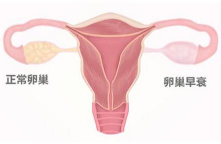 卵巢提前早衰怎么办