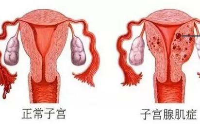 子宫腺肌症严重的症状表现