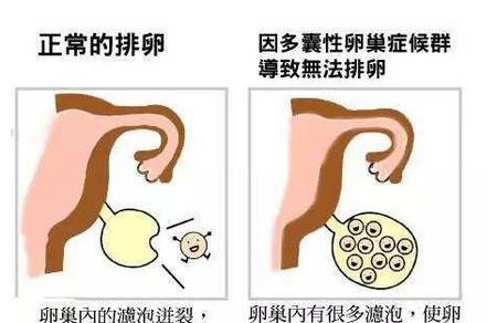 什么情况下需要促排卵