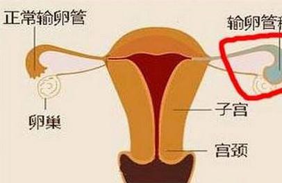 做试管发现输卵管积水该怎么办